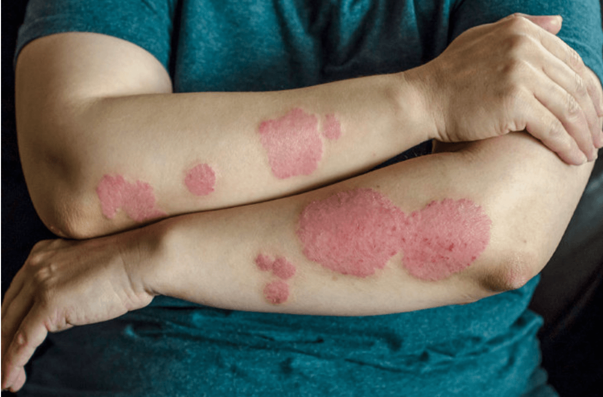 Is Psoriasis Hereditary?