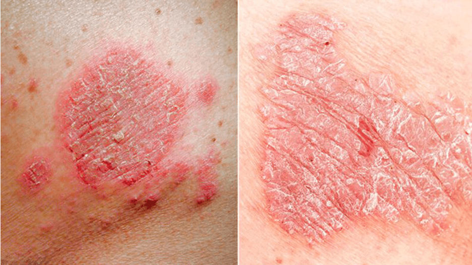 What Is the Difference Between Eczema and Psoriasis?