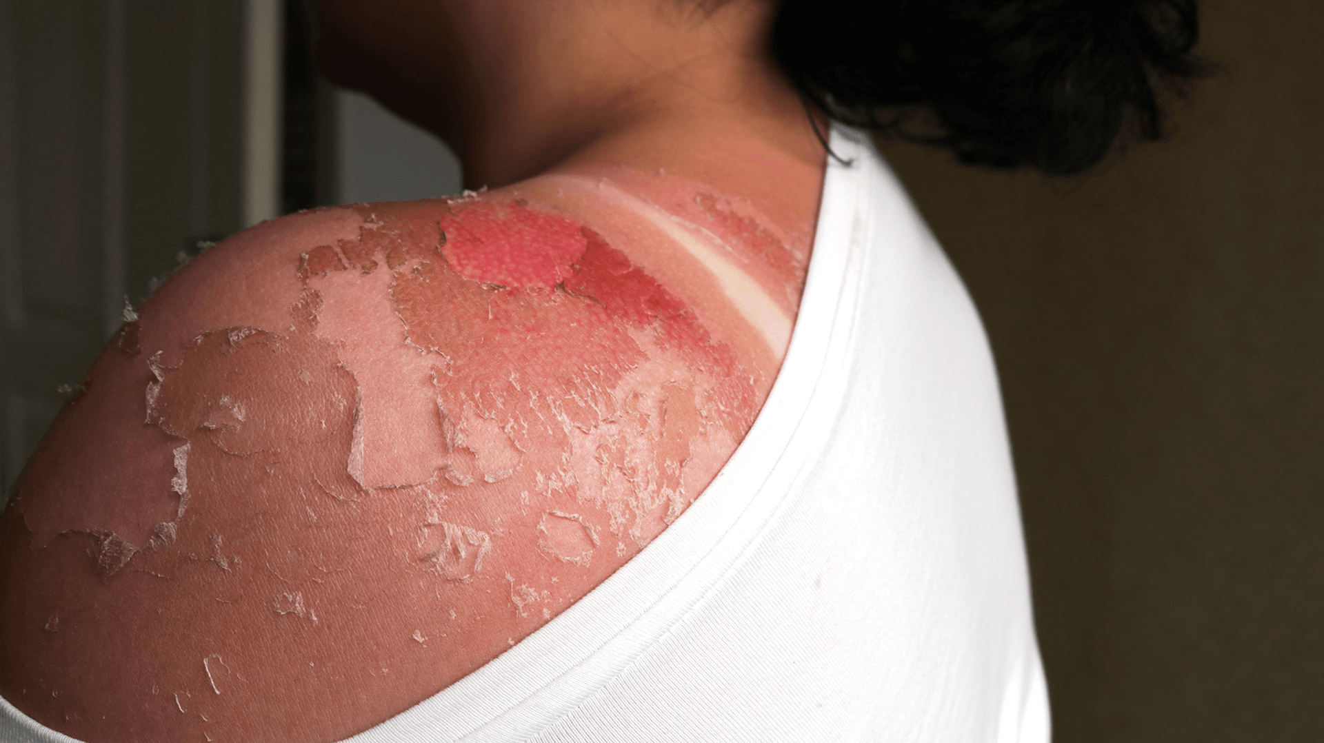 A woman's back with a massive sun burn