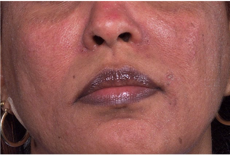 African american woman with Rosacea