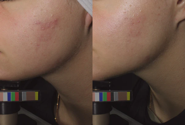 Before and after image of a persons cheek that had acne on it.