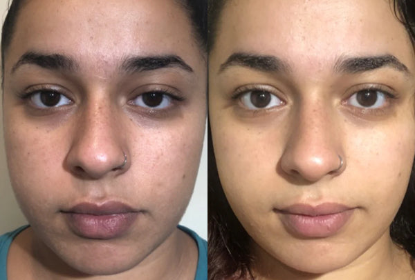 Before and after image of a woman's face with acne issues.